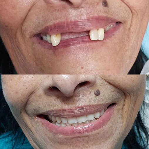 Reabilitação com lentes de contato dental no Morumbi