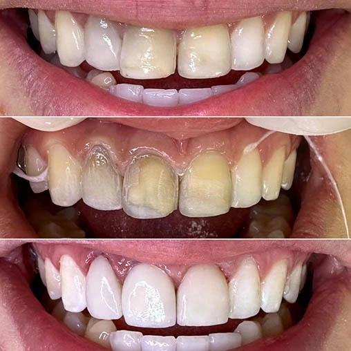 Implante dentário antes e depois — dentista implantodontista
