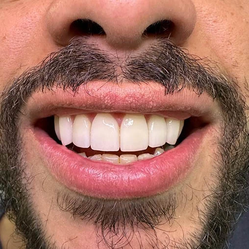 Prótese dentária resultado natural — Sorridents Morumbi