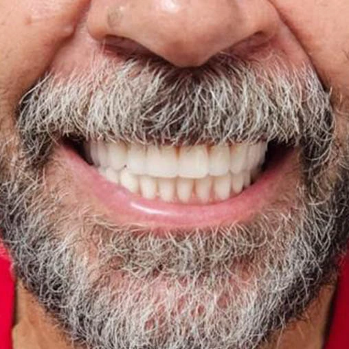 Restauração estética em resina — clínica odontológica Morumbi