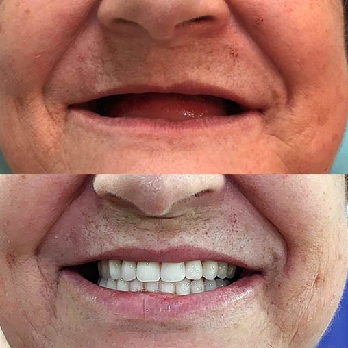 Harmonização do sorriso com dentista no Morumbi