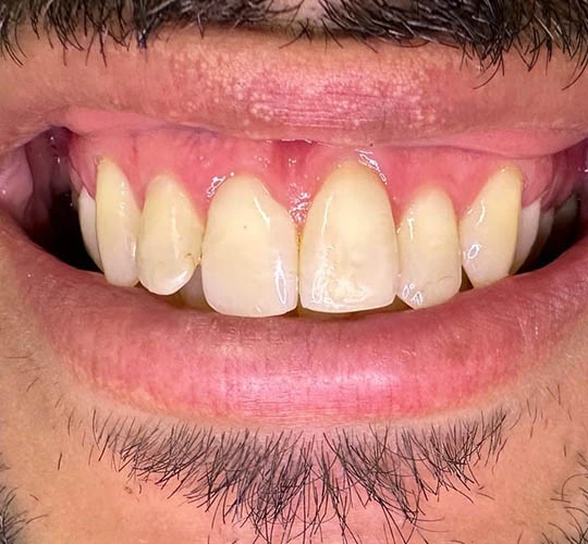 Sorriso antes do tratamento odontológico na Sorridents Morumbi