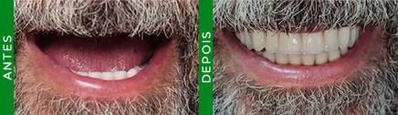 Paciente com dificuldade para mastigar antes da colocação de prótese dental fixa