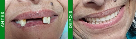 Prótese protocolo dentária fixada sobre 4 implantes — Sorridents Morumbi