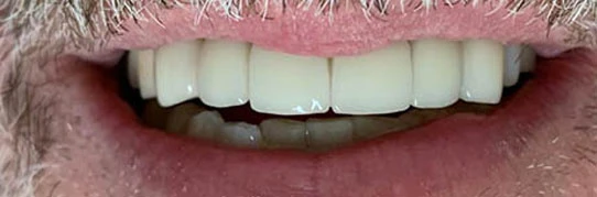 Sorriso restaurado com prótese dentária fixa sobre implantes — Sorridents Morumbi