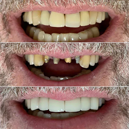 Paciente sorrindo após reabilitação com prótese dentária na Sorridents Morumbi