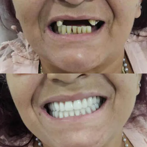 Close de sorriso natural obtido com prótese dental fixa sobre implantes