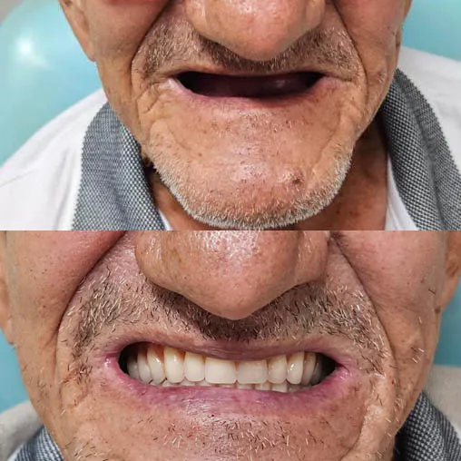 Antes e depois de tratamento com prótese dentária no Morumbi/SP