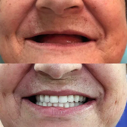 Prótese protocolo superior fixada sobre implantes dentários — Sorridents Morumbi