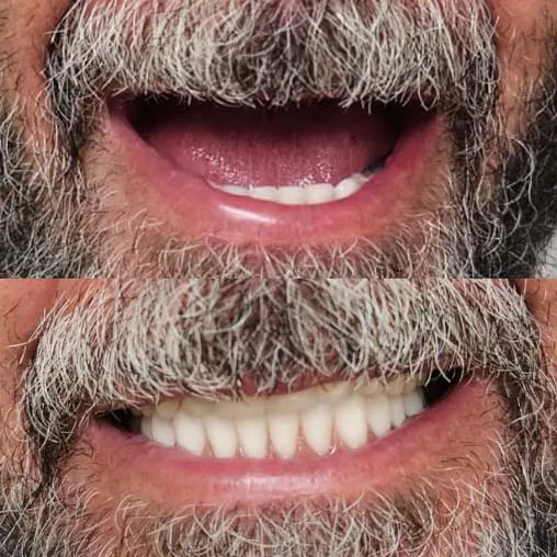 Mulher sorrindo com confiança após colocação de prótese dental na Vila Sonia, São Paulo